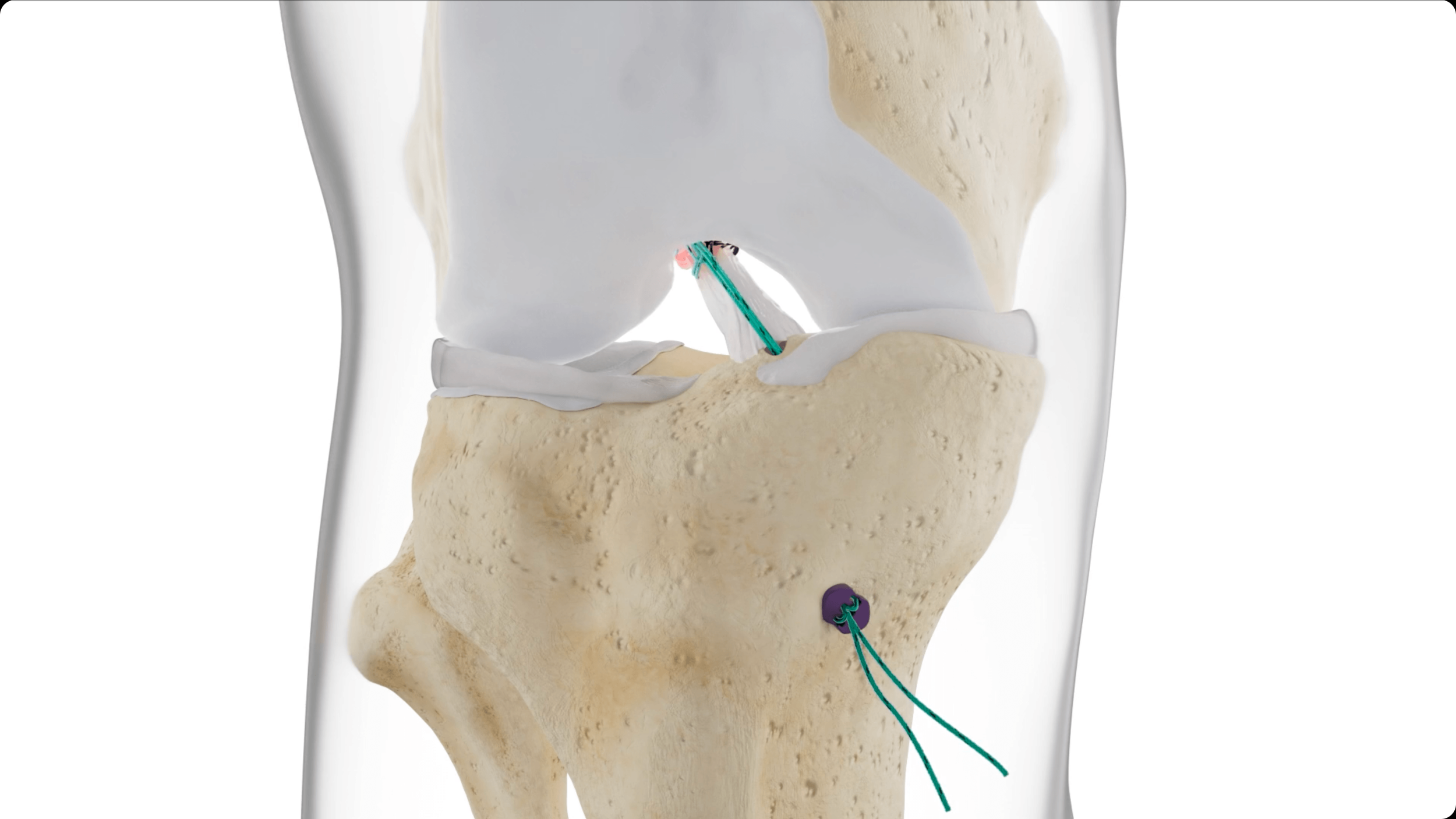Surgical Technique | Native Orthopaedics
